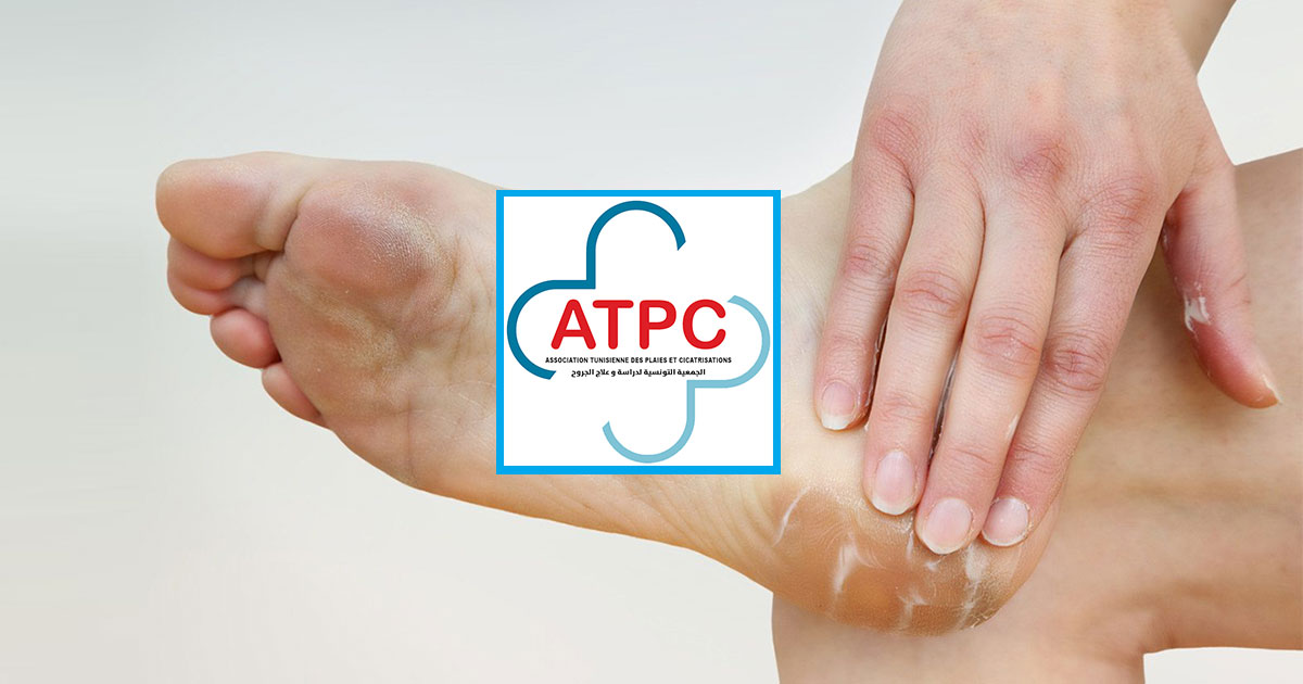   اعطيت اشارة انطلاقه امس.. افتتاح اول مركز افريقي متخصص في التئام الجروح