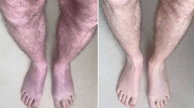 "الأقدام الزرقاء".. مريض يكتشف مرضا غريبا لكورونا طويل الأمد