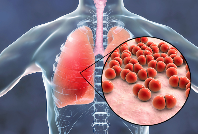الكشف المبكر هو الحلّ..  وزارة الصحة تؤكد تسجيل 3114 إصابة جديدة بالسل في 2023