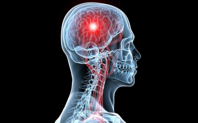 أستاذة في طب الأعصاب: تونس تسجل كل 30 دق إصابة جديدة بالجلطة الدماغية وحالة وفاة كل ساعتين