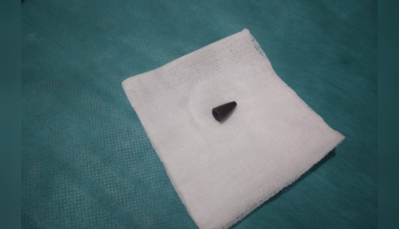 مدنين.. نجاح جديد لفريق الأمراض الصدرية بالمستشفى الجامعي الحبيب بورقيبة 