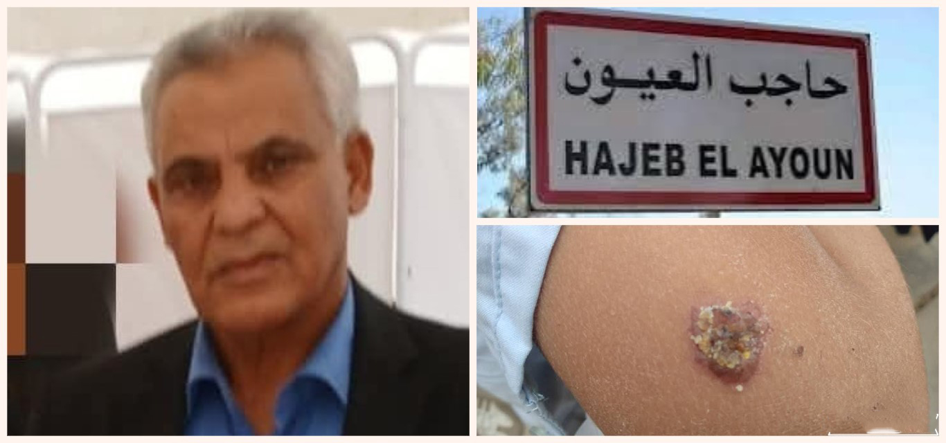 المدير الجهوي للصحة بالقيروان لـ"الصباح نيوز": 80 إصابة بالليشمانيوز بحاجب العيون و الوضع تحت السيطرة والدواء متوفر" 