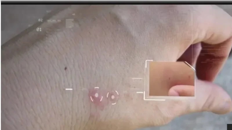 تحذير من انتشارها.. إصابات بـ«الليشمانيا» الجلدية بين القصرين والقيروان