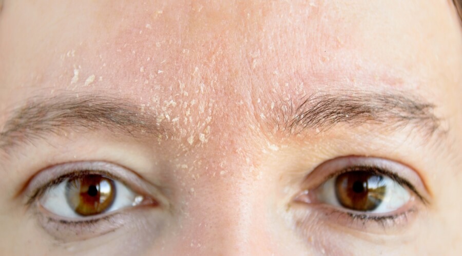 بشرة باهتة في الشتاء؟.. الأسباب والحلول