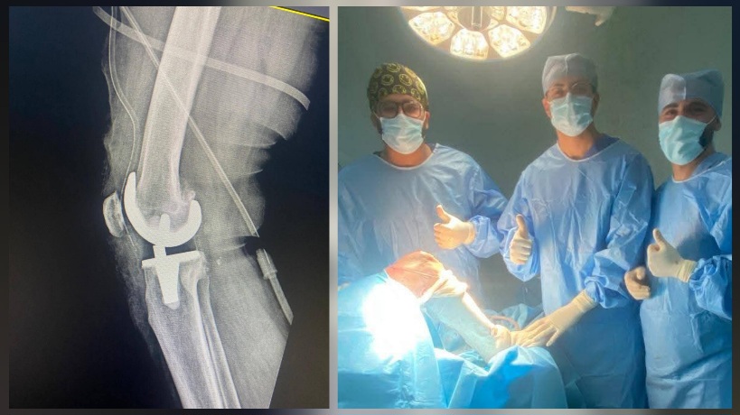  أول عملية زرع مفصل ركبة كامل بالمستشفى الجهوي بجندوبة